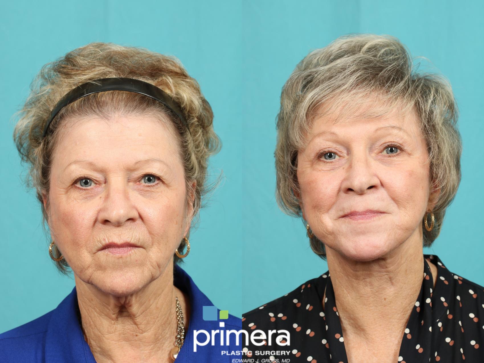 Before & After Neck Lift Case 605 Front View in Orlando, Florida