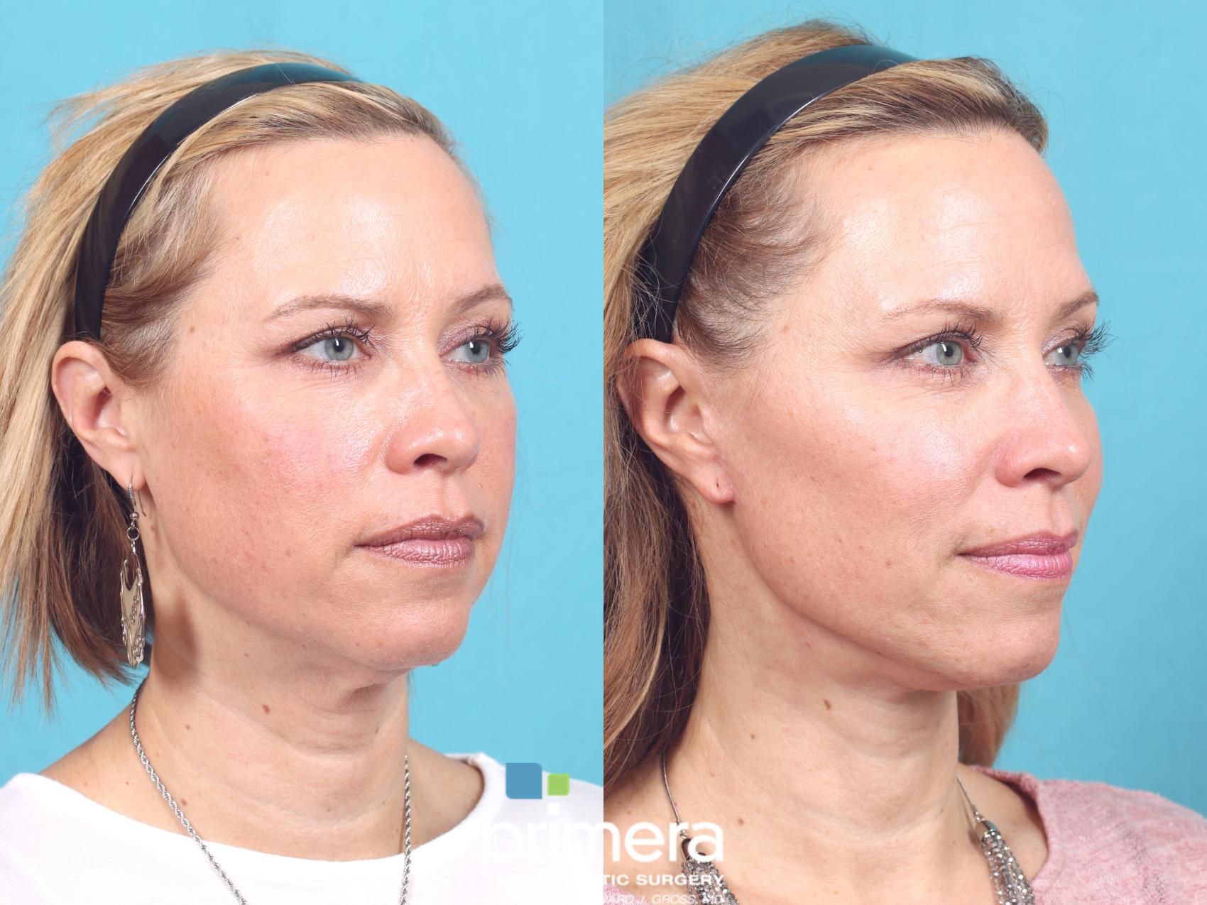 3 Ways to Slim Your Face (Non-Surgically) - Skin NV Tampa Med Spa