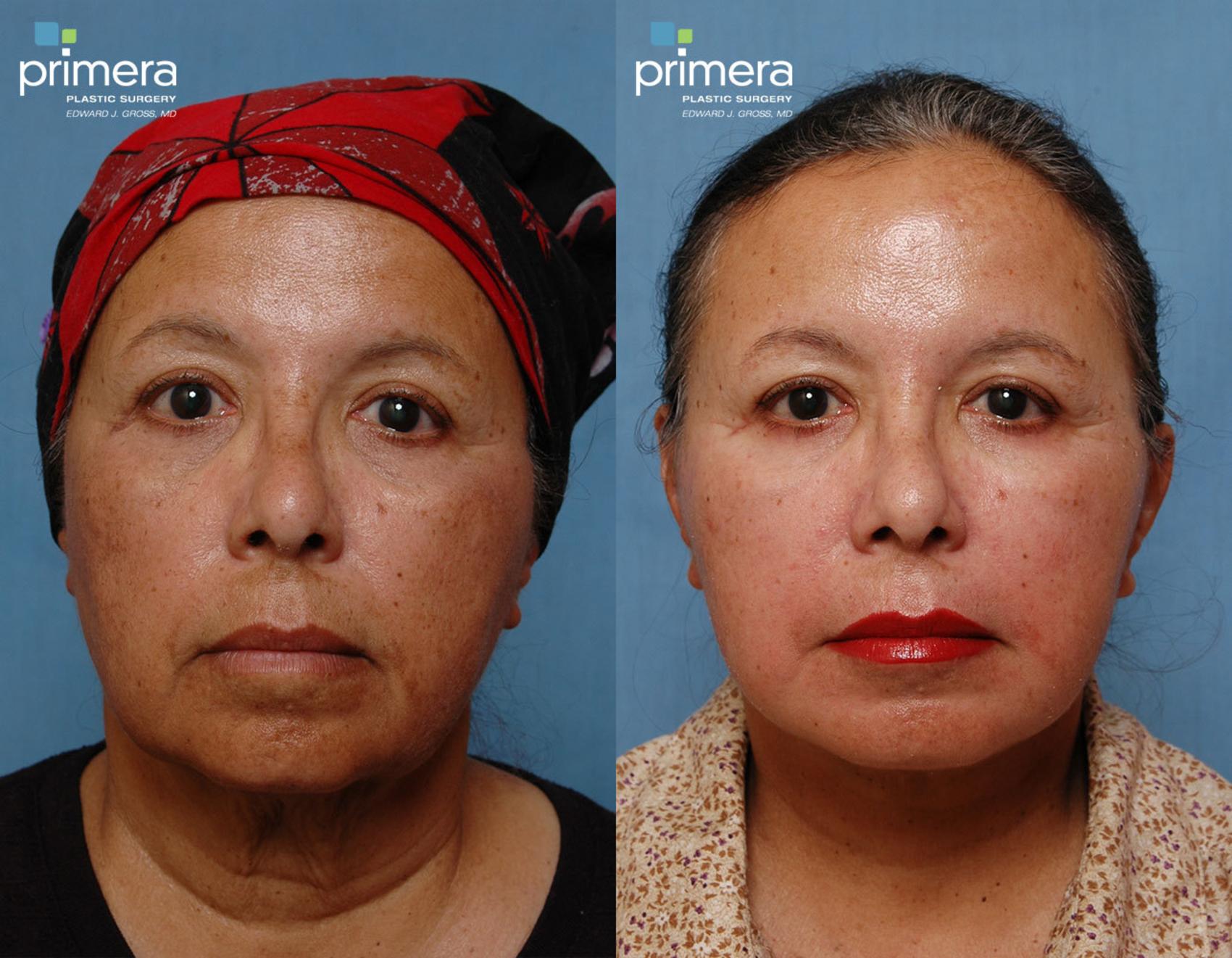 Mini Facelift Before & After Photos Patient 69 Orlando