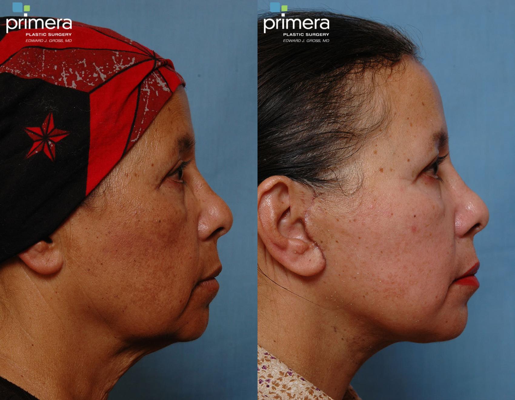 Mini Facelift Before & After Photos Patient 69 Orlando