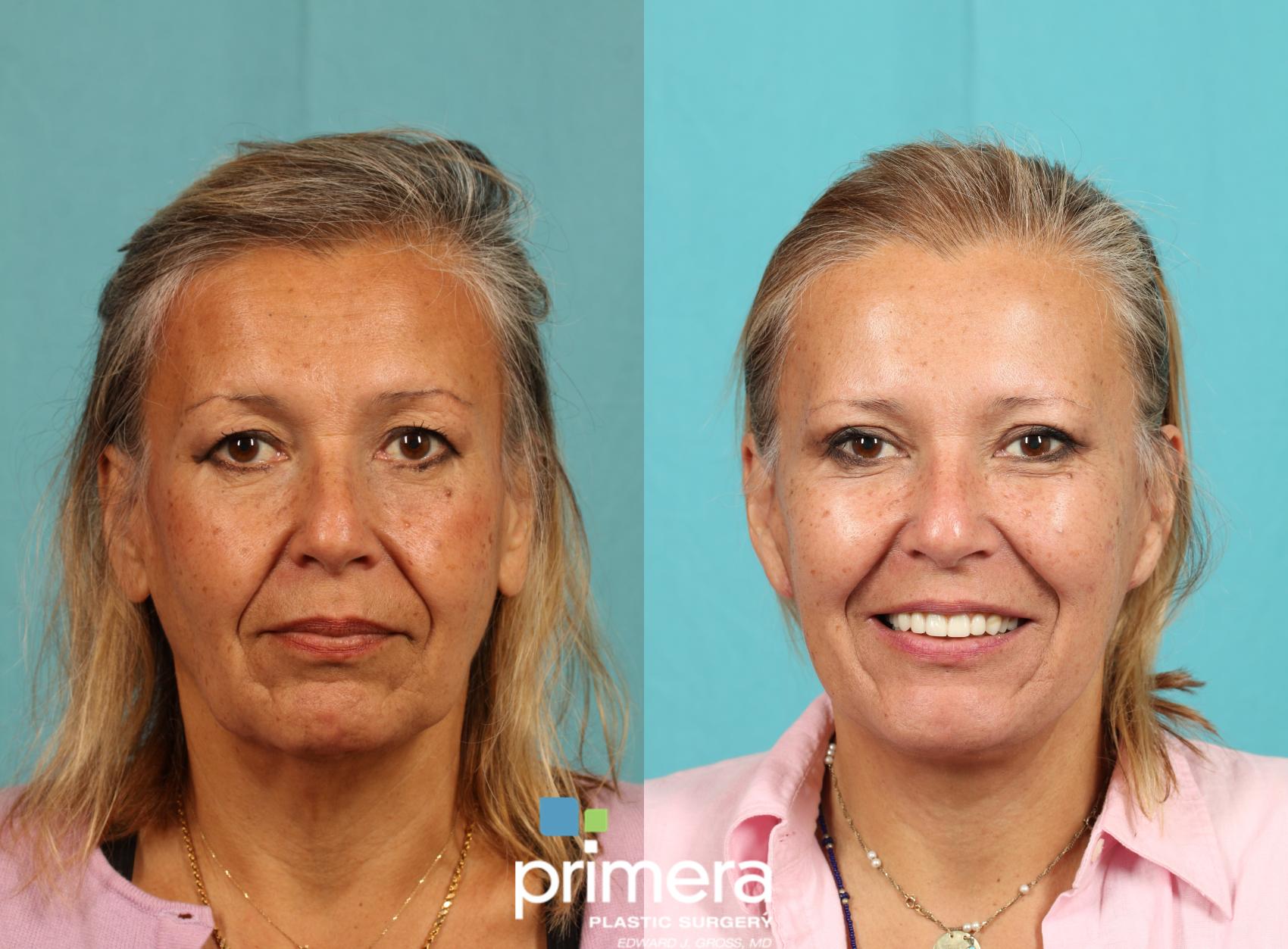 Before & After Neck & Face Liposuction Case 770 Front View in Orlando, Florida