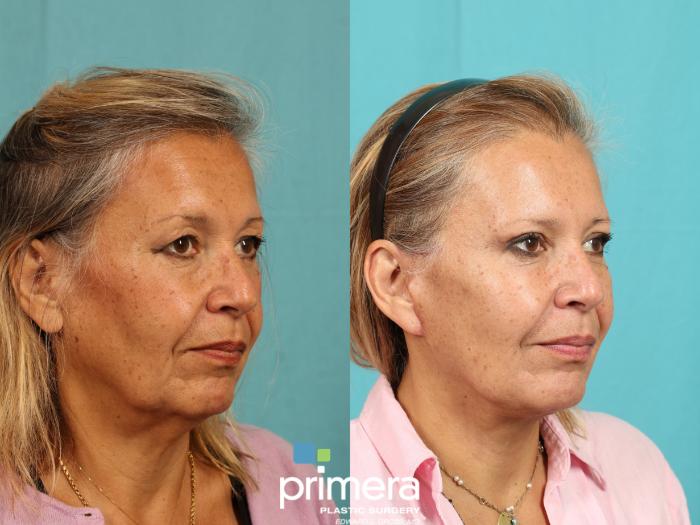 Before & After Mini Facelift Case 770 Right Oblique View in Orlando, Florida
