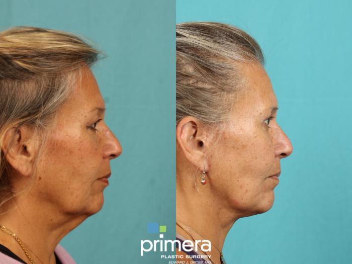 Before & After Mini Facelift Case 770 Right Side View in Orlando, Florida