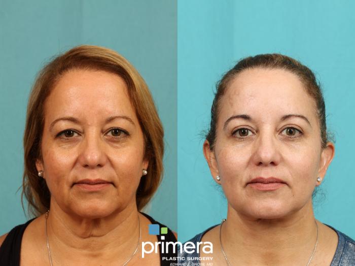 Before & After Blepharoplasty Case 771 Front View in Orlando, Florida