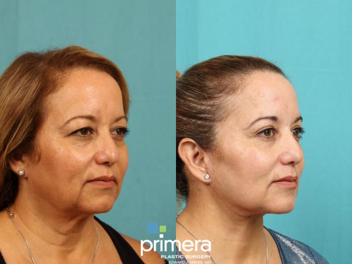 Before & After Mini Facelift Case 771 Right Oblique View in Orlando, Florida
