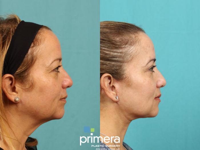 Before & After Blepharoplasty Case 771 Right Side View in Orlando, Florida