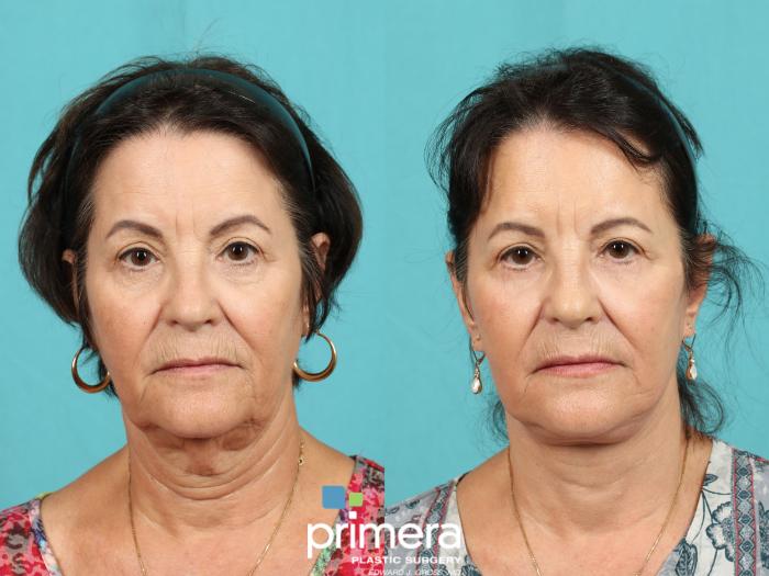 Before & After Neck Lift Case 774 Front View in Orlando, Florida