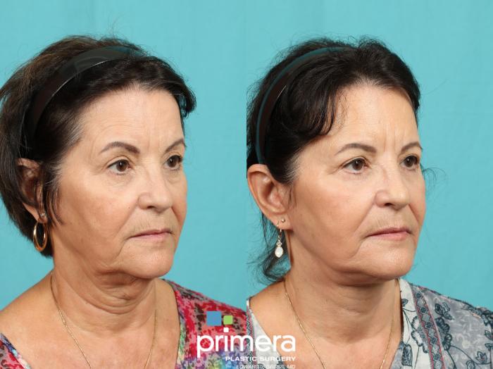Before & After Neck Lift Case 774 Right Oblique View in Orlando, Florida