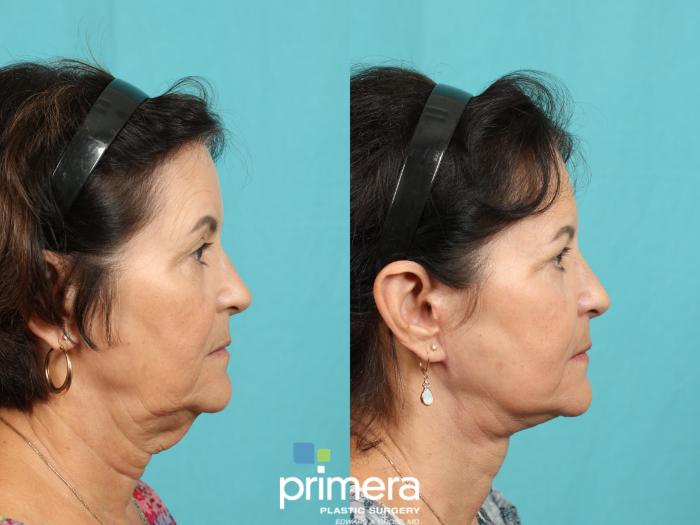 Before & After Mini Facelift Case 774 Right Side View in Orlando, Florida