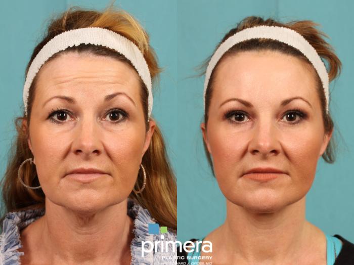 Before & After Mini Facelift Case 775 Front View in Orlando, Florida