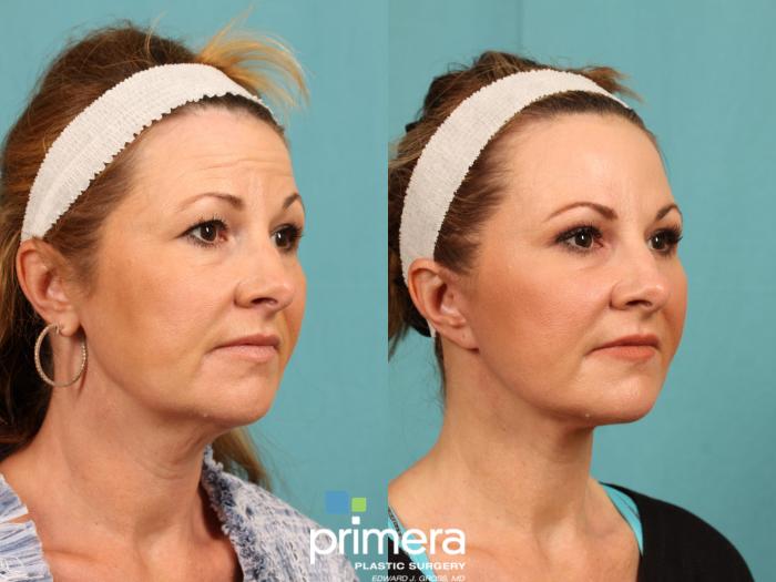Before & After Brow Lift Case 775 Right Oblique View in Orlando, Florida