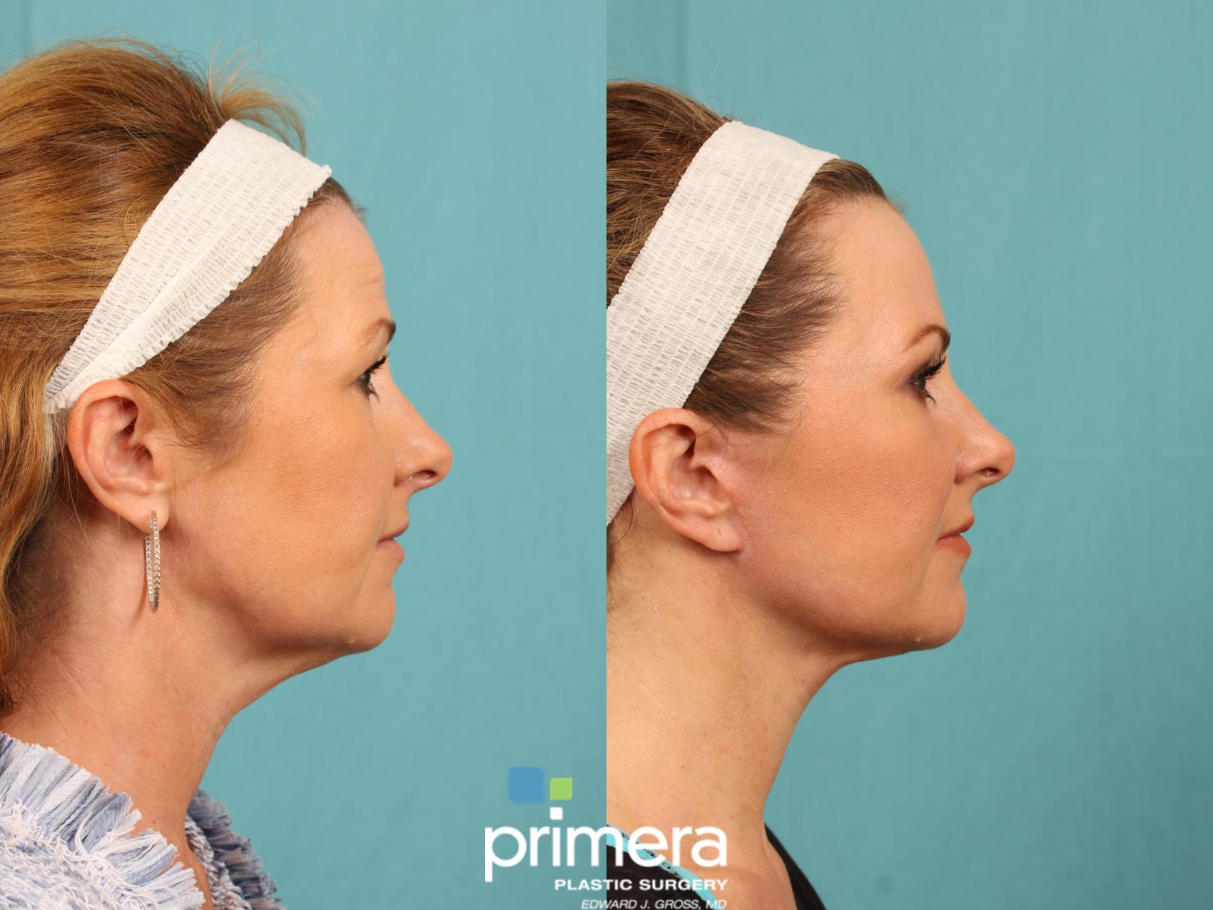 Before & After Blepharoplasty Case 775 Right Side View in Orlando, Florida