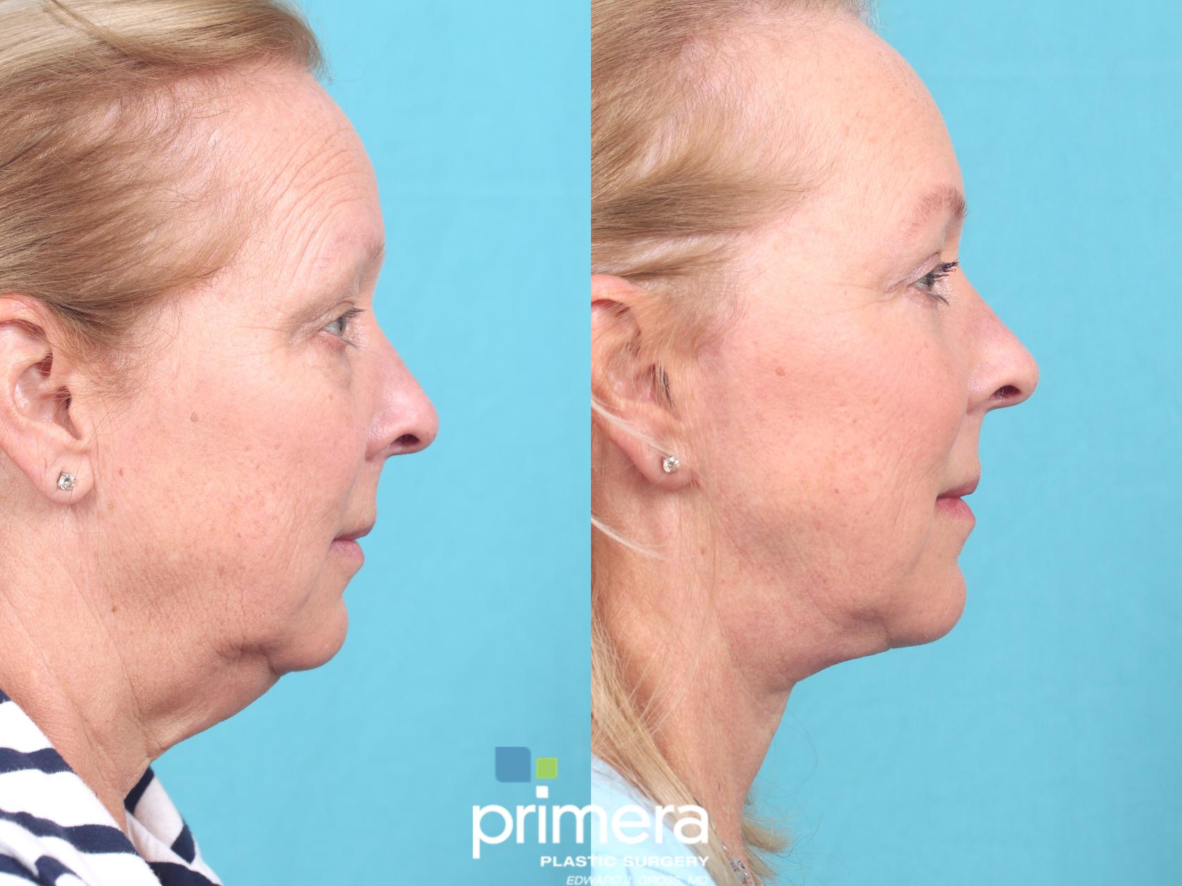 Mini Facelift/ Neck lift in Orlando, FL