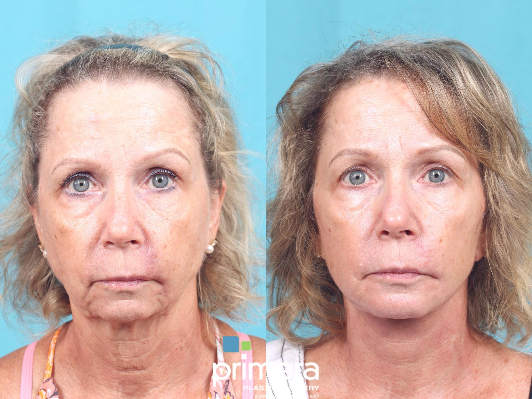 mini-facelift-before-and-after-pictures-case-791-orlando-florida