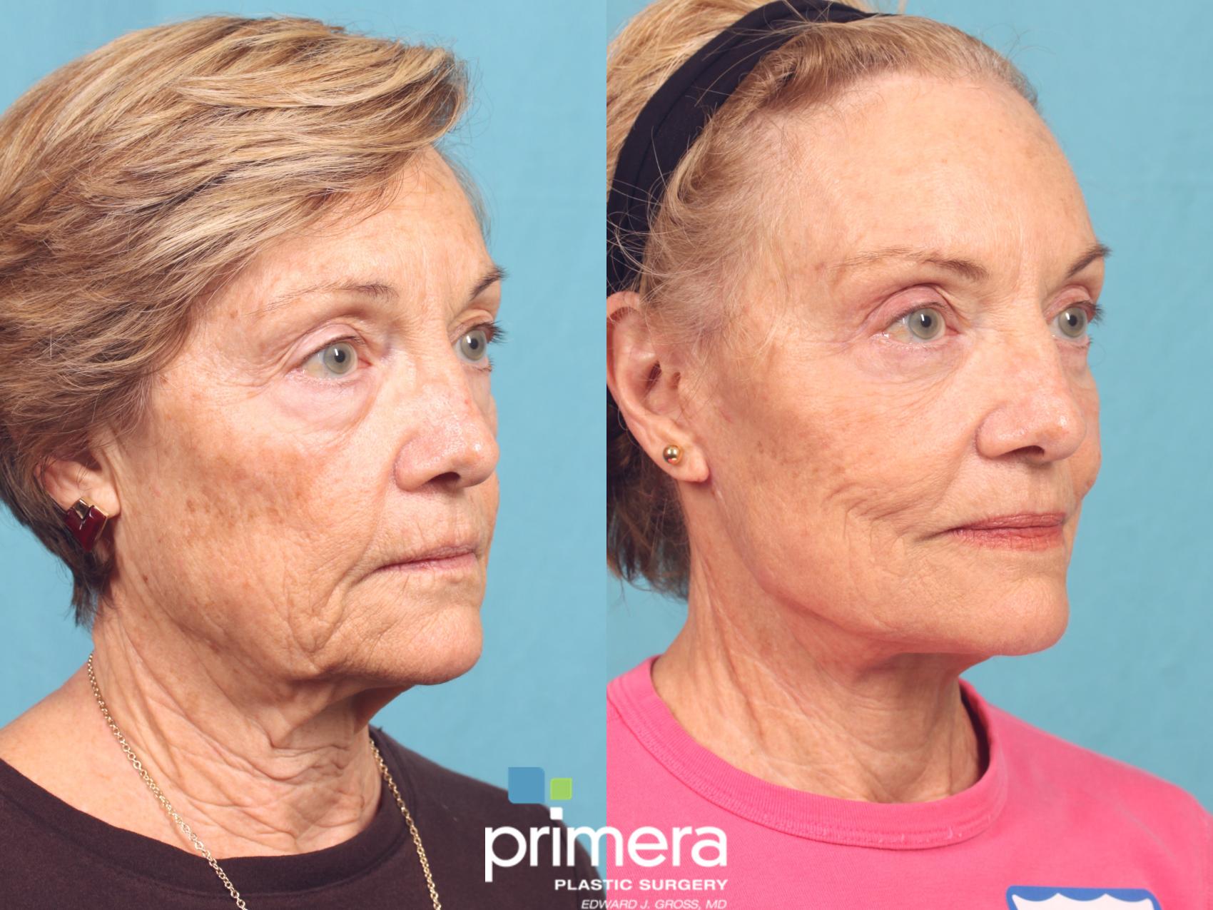 Before & After Mini Facelift Case 810 Right Oblique View in Orlando, Florida