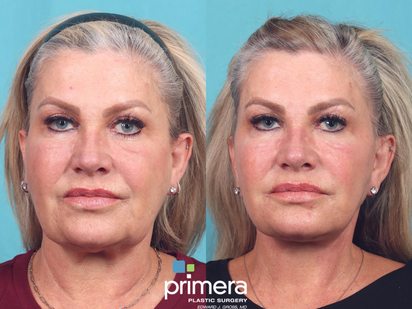 Laser Skin Resurfacing (DOT CO2) Before and After Pictures Case 904