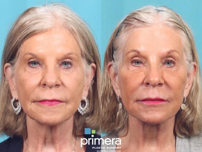 Before & After Endoscopic Forehead Lift Case 920 Front View in Orlando, Florida