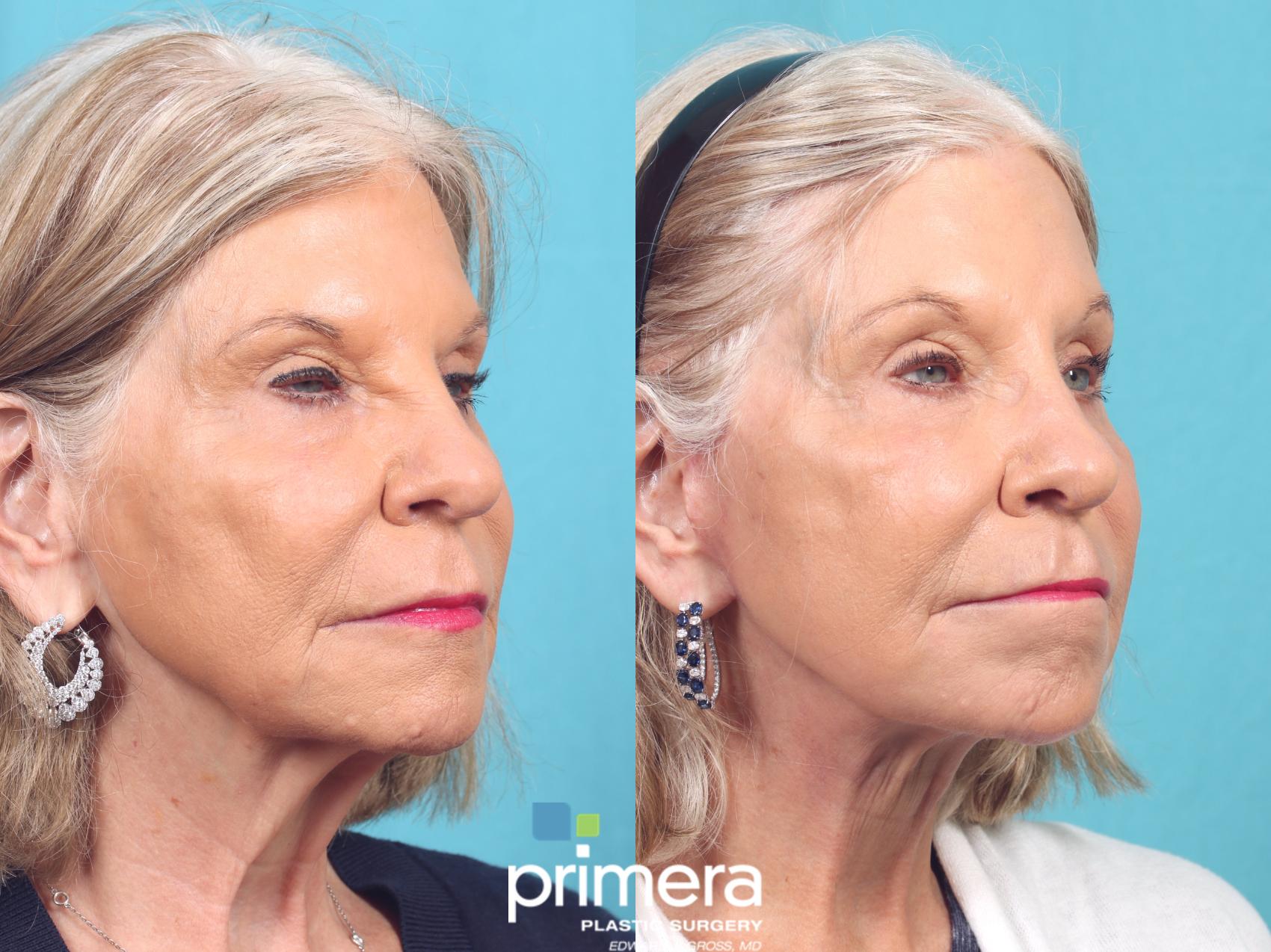 Before & After Neck Lift Case 920 Right Oblique View in Orlando, Florida