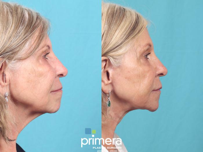 Before & After Mini Facelift Case 920 Right Side View in Orlando, Florida
