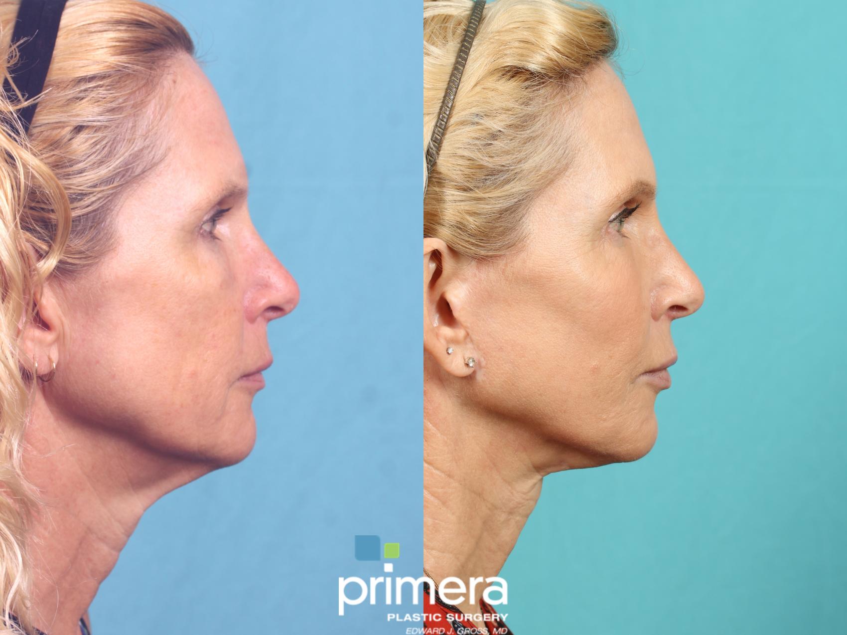 Mini Facelift | Before Photo  | Primera Plastic Surgery | Orlando, FL