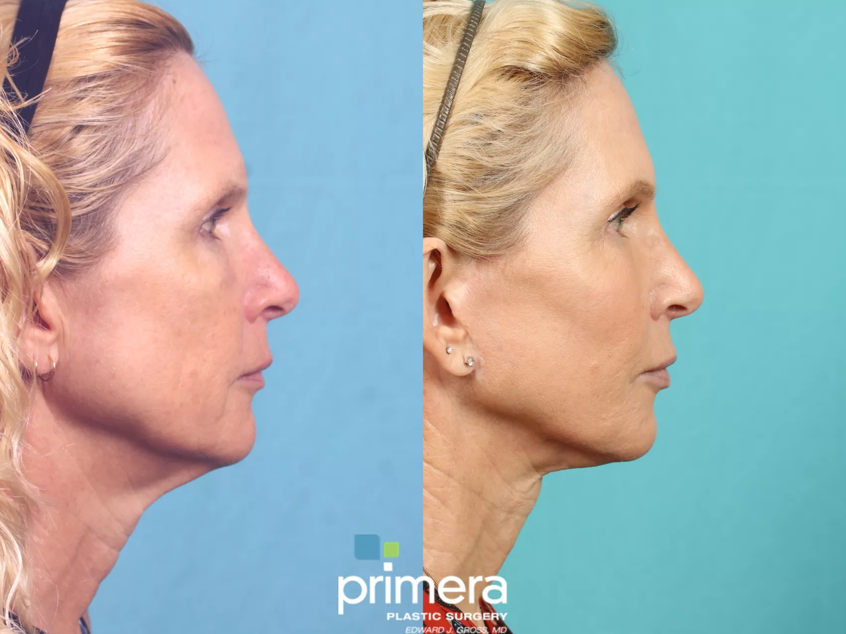 顔の外科 = FACIAL SURGERY mini-facelift-923-right-side-