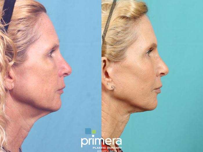 Mini Facelift | Before Photo  | Primera Plastic Surgery | Orlando, FL