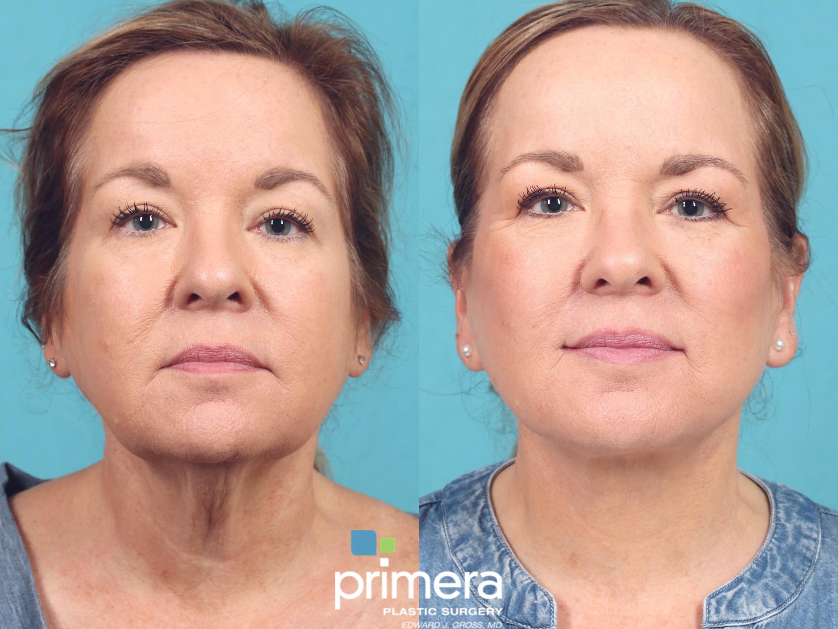 How Much Does A Mini Facelift Cost In Florida Mini Facelift Before and After Pictures Case 924 | Orlando, Winter Park