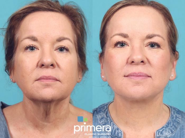 Before & After Mini Facelift Case 924 Front View in Orlando, Florida