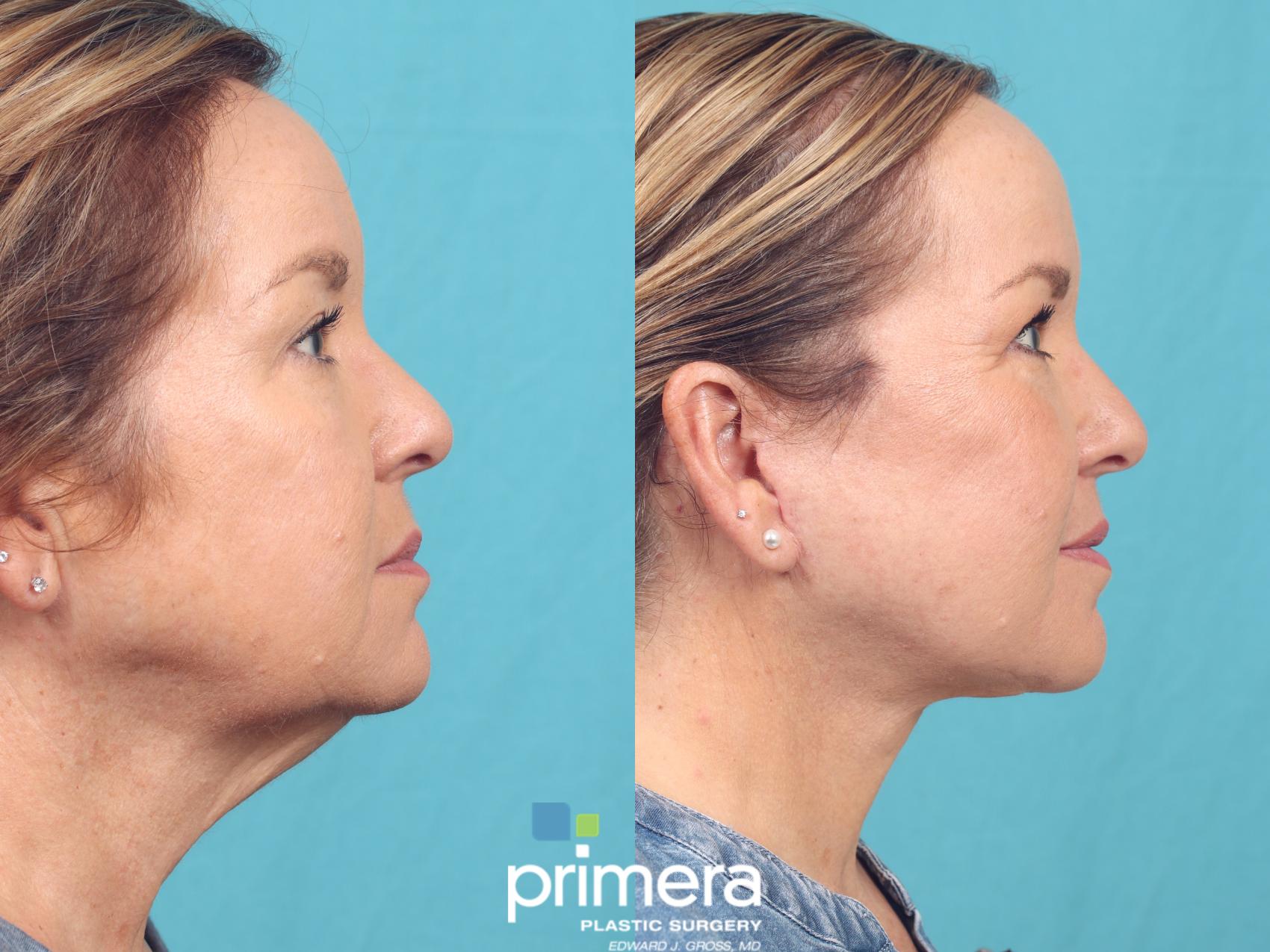 Before & After Mini Facelift Case 924 Right Side View in Orlando, Florida