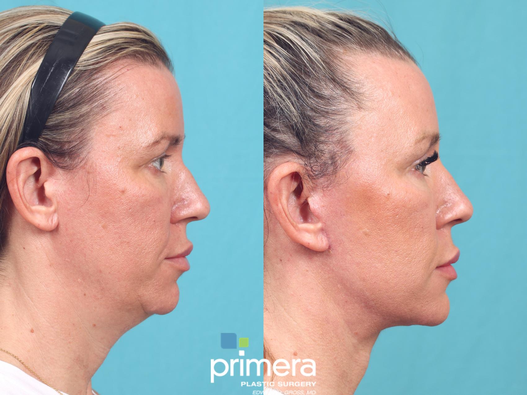 Before & After Neck Lift Case 939 Right Side View in Orlando, Florida