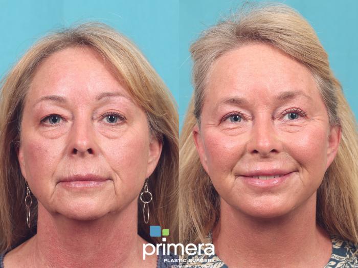 Before & After Blepharoplasty Case 971 Front View in Orlando, Florida