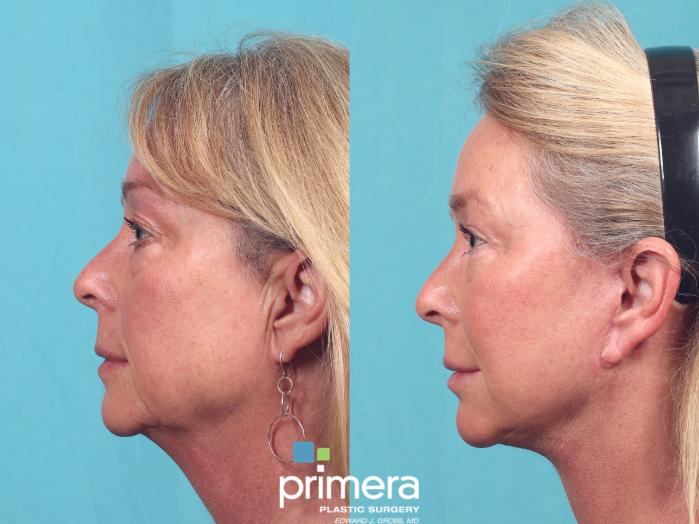 Before & After Mini Facelift Case 971 Left Side View in Orlando, Florida