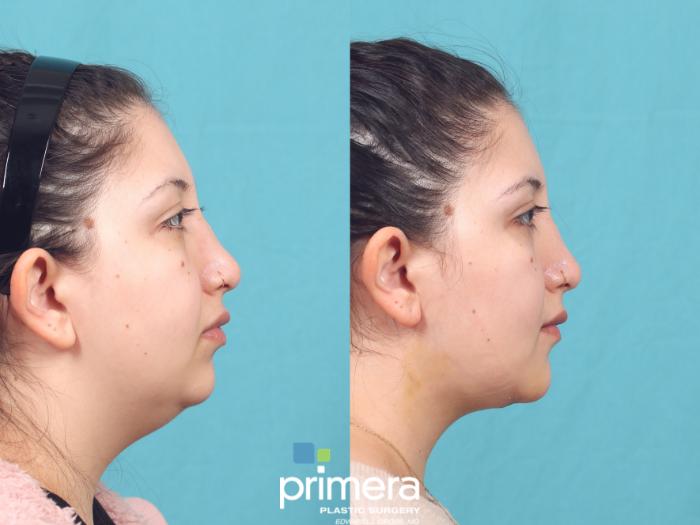Before & After Neck & Face Liposuction Case 1043 Right Side View in Orlando, Winter Park & Tampa, Florida
