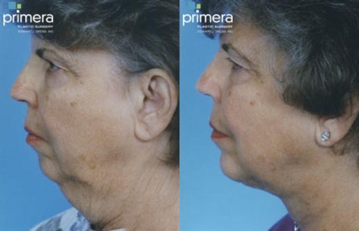 Before & After Chin & Cheek Implant Case 125 view-1 View in Orlando, Florida