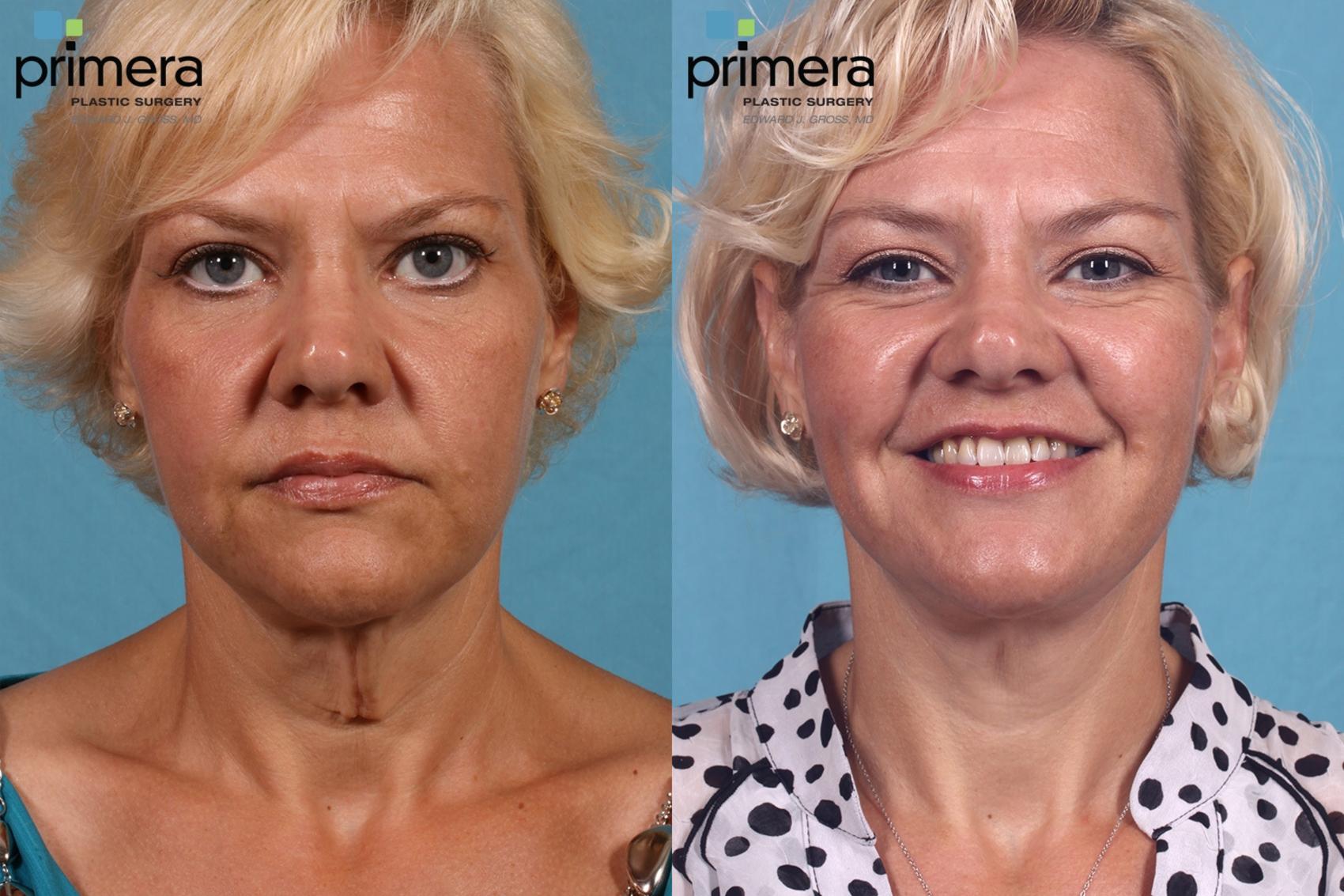 Before & After Neck & Face Liposuction Case 126 view-1 View in Orlando, Florida