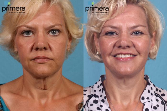 Before & After Facelift Case 126 view-1 View in Orlando, Florida