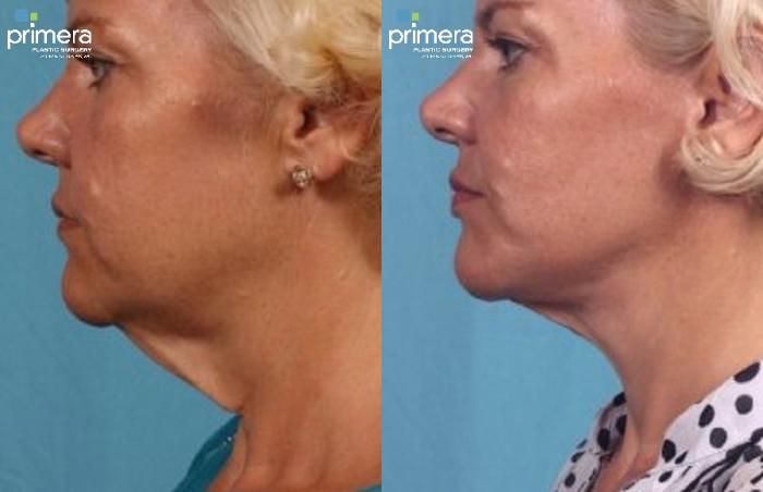 Before & After Facelift Case 126 view-2 View in Orlando, Florida