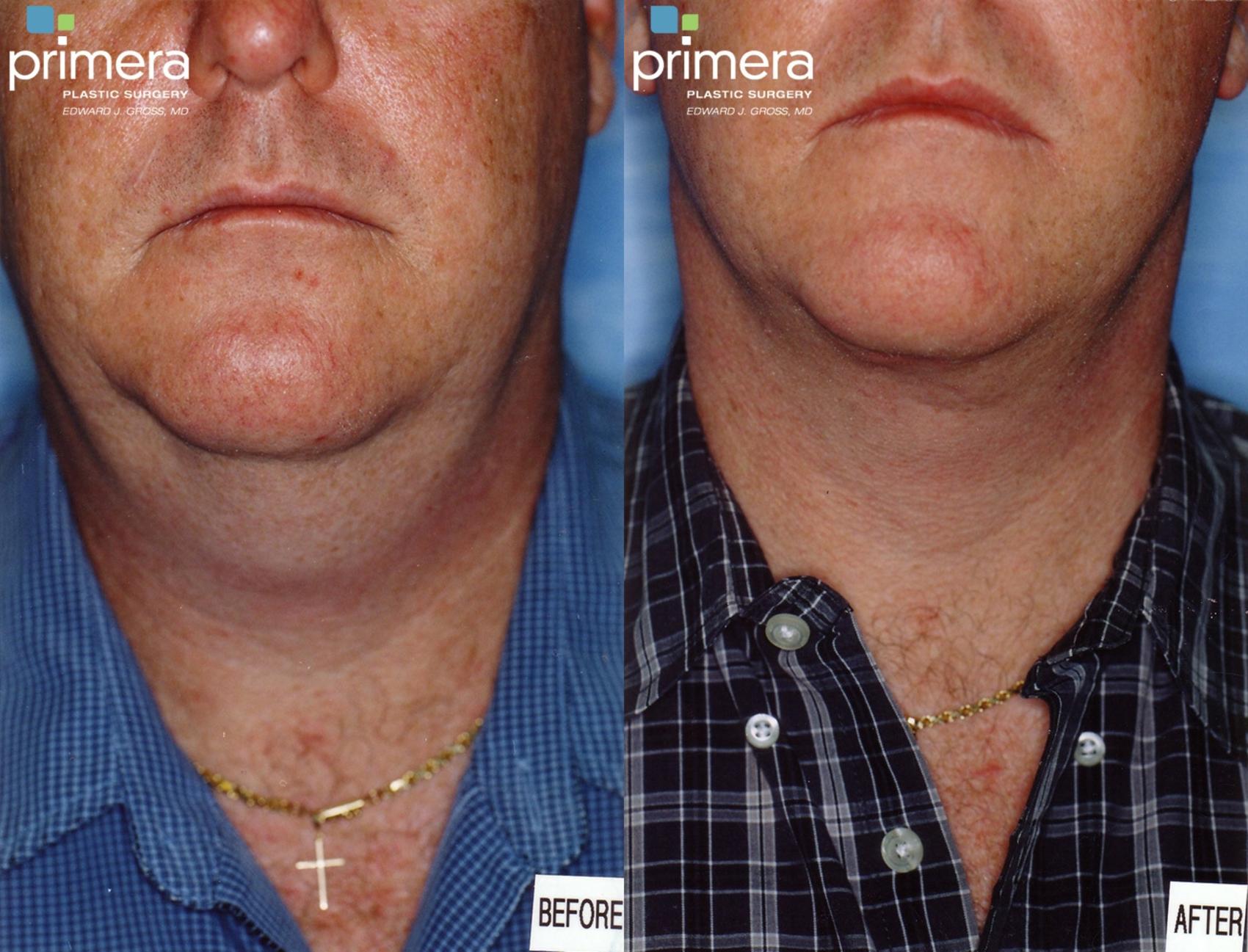 Before & After Neck & Face Liposuction Case 136 view-1 View in Orlando, Florida