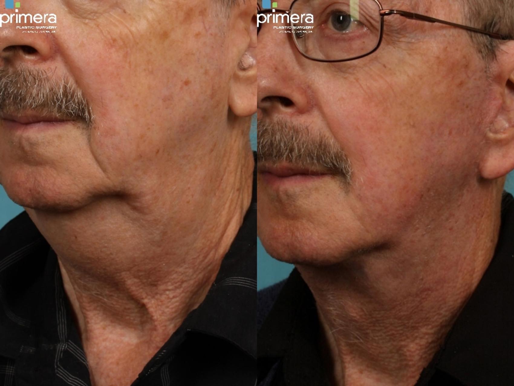 Before & After Surgery for Men Case 193 view-1 View in Orlando, Florida