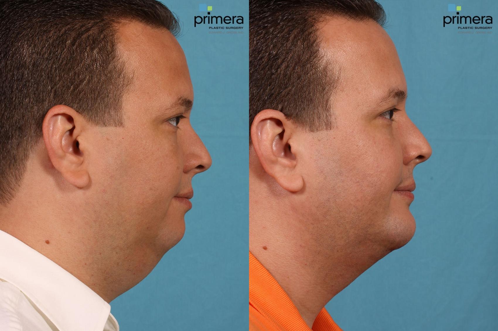 Neck And Face Liposuction Before And After Photos Patient 73 Orlando