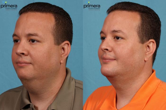 Before & After Surgery for Men Case 73 view-2 View in Orlando, Florida