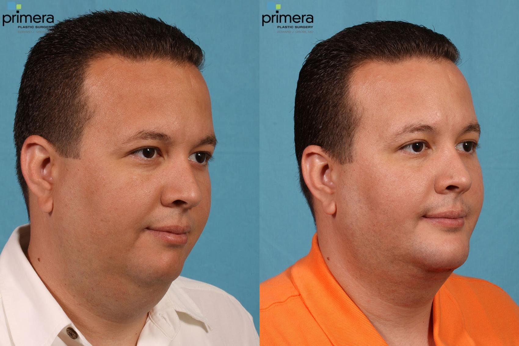 Before & After Neck & Face Liposuction Case 73 view-3 View in Orlando, Florida
