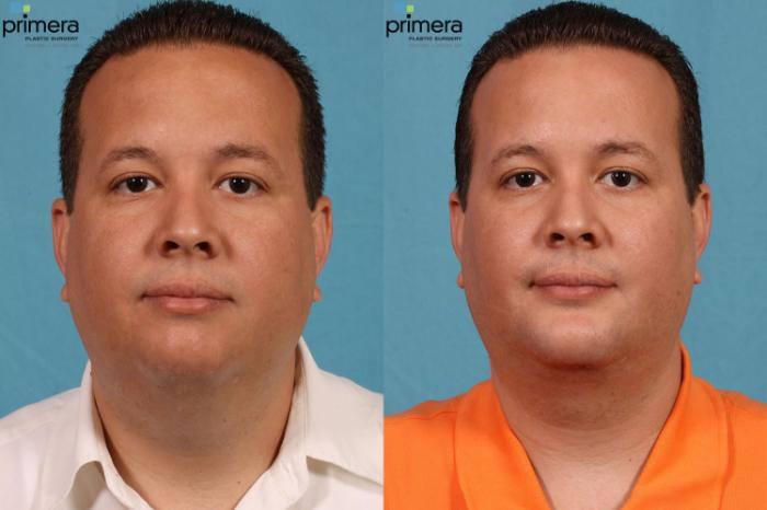Before & After Neck & Face Liposuction Case 73 view-4 View in Orlando, Florida