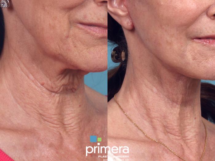 Before & After Neck Lift Case 1039 Right Oblique View in Orlando, Winter Park & Tampa, Florida
