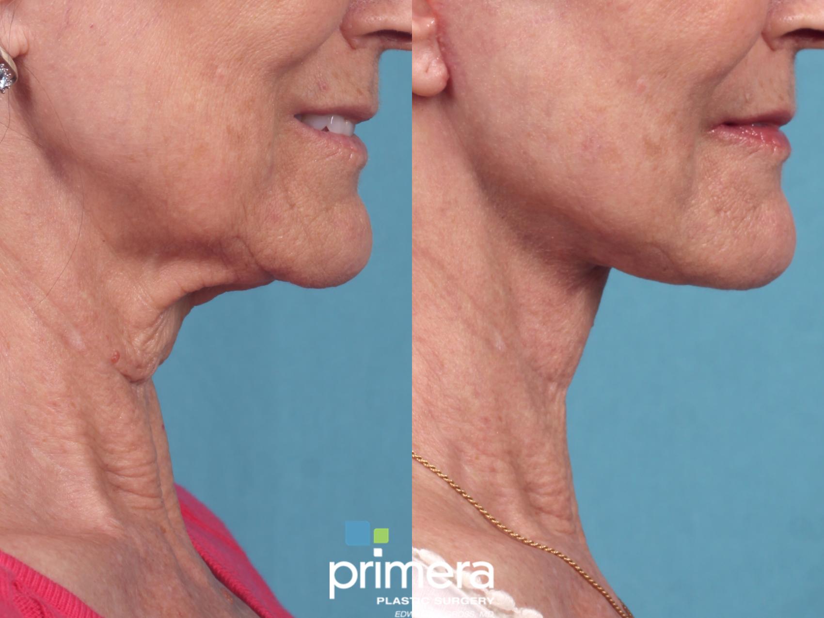Before & After Neck Lift Case 1039 Right Side View in Orlando, Winter Park & Tampa, Florida
