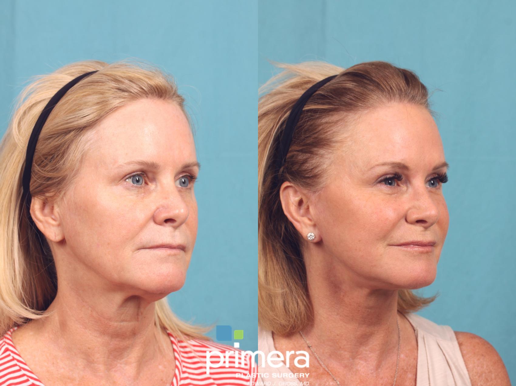Before & After Neck Lift Case 1041 Right Oblique View in Orlando, Winter Park & Tampa, Florida