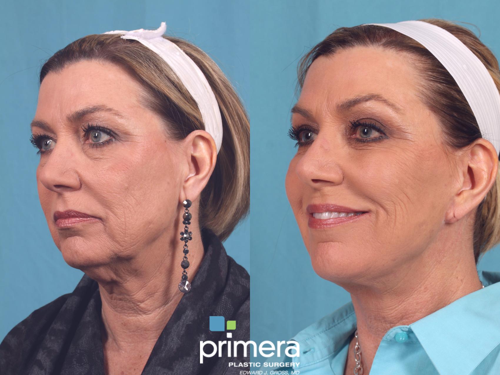Before & After Neck Lift Case 257 Left Oblique View in Orlando, Florida