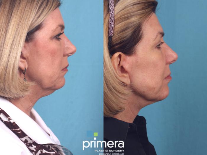Before & After Neck Lift Case 257 Right Side View in Orlando, Florida