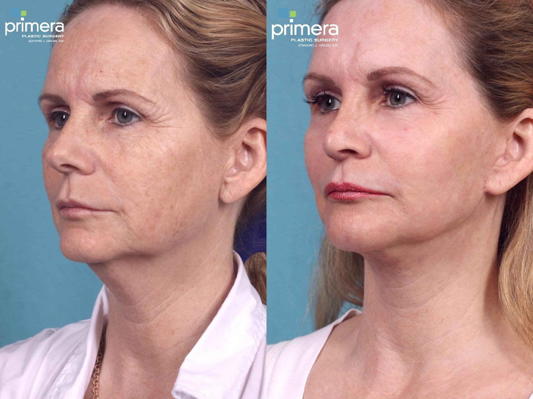 Before & After Chemical Peel Case 338 view-1 View in Orlando, Winter Park & Tampa, Florida