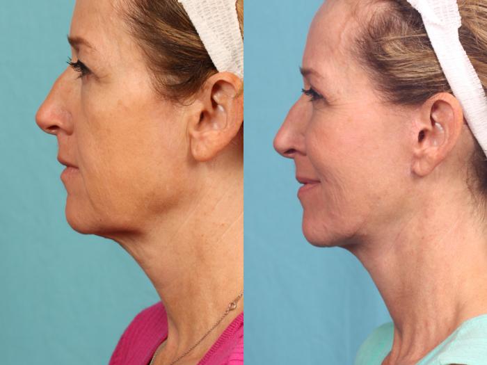 Before & After Neck Lift Case 496 Left Side View in Orlando, Florida